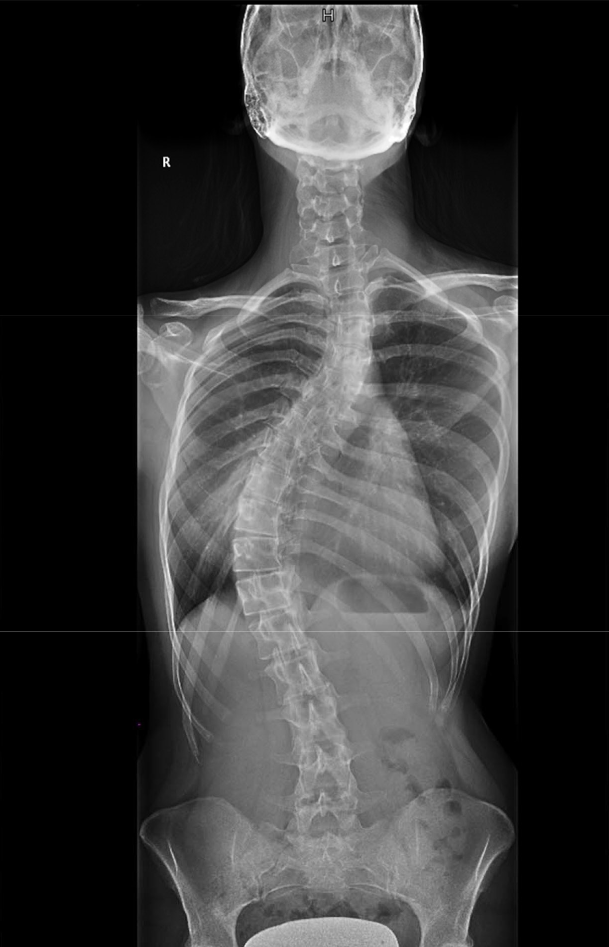 Wirbelsäule Röntgenbild