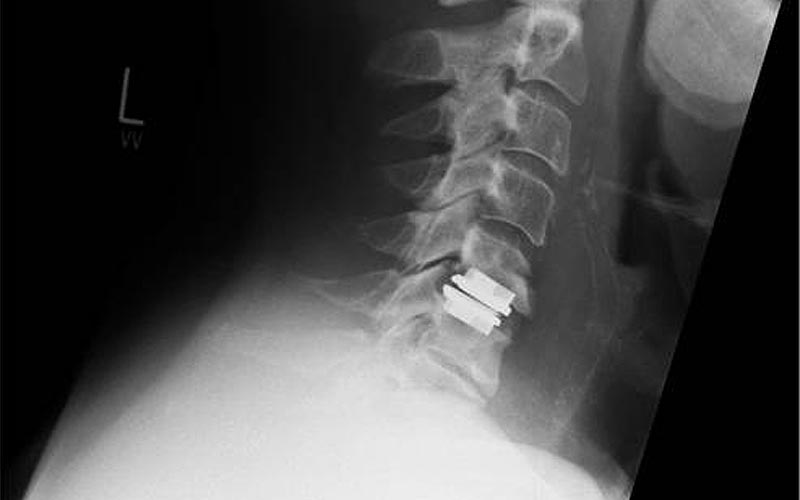 arthrose hws