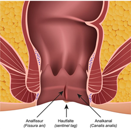 Analfissur (Proktologie)