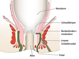 Analfisteln (Proktologie)