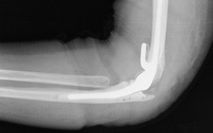 Röntgenbild: Gekoppelte Prothese des Ellenbogengelenkes bei instabilem und zerstörten Gelenk nach einem Verrenkunsbruch.