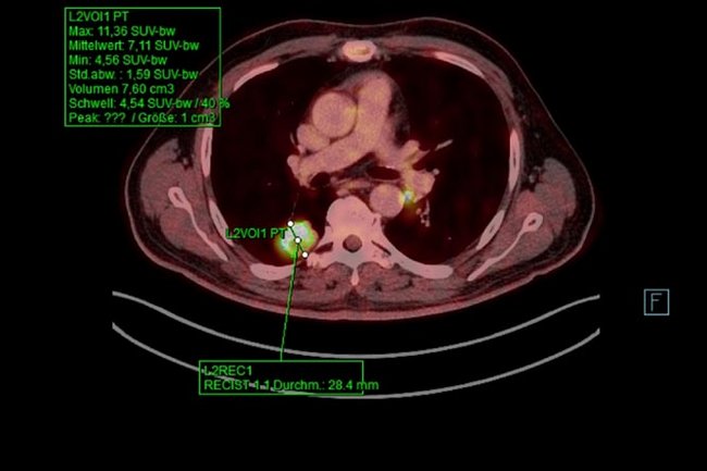 Untersuchung PET-CT