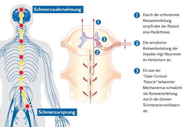 Epidurale Nervenstimulation (SCS): Schmerzursprung /Schmerzwahrnehmung / 