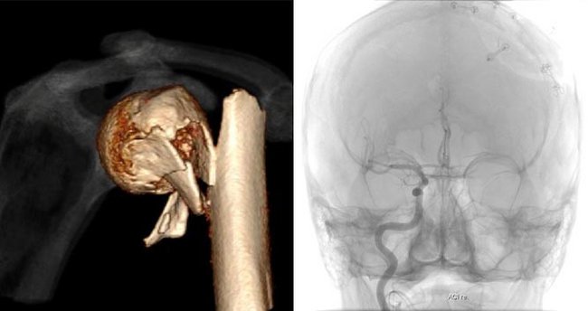 Gebrochener Oberarm (links); Gefäßdarstellung Schädel (rechts)