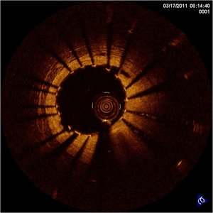 Optische Kohärenztomografie im Gefäß/Stent