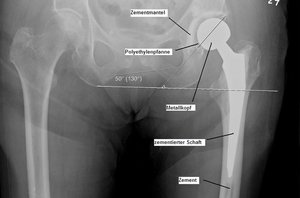 Röntgen-Bild einer zementieren Hüft-Prothese