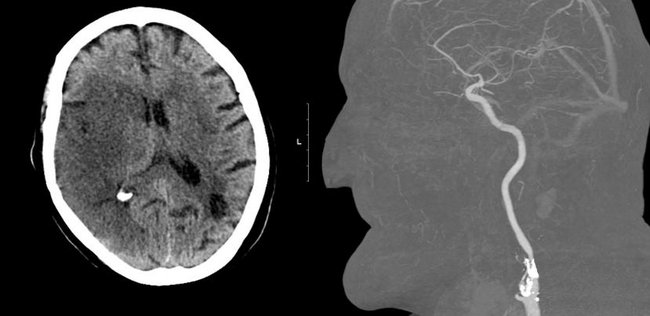 Neuroradiologie, CT: Rechtshirniger Schlaganfall, Ursache ist eine kalkhaltige Verengung der Halsschlagader 