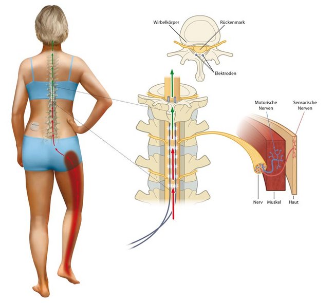 Epidurale Nervenstimulation (SCS): Schmerzwahrnehmung / Schmerzursprung