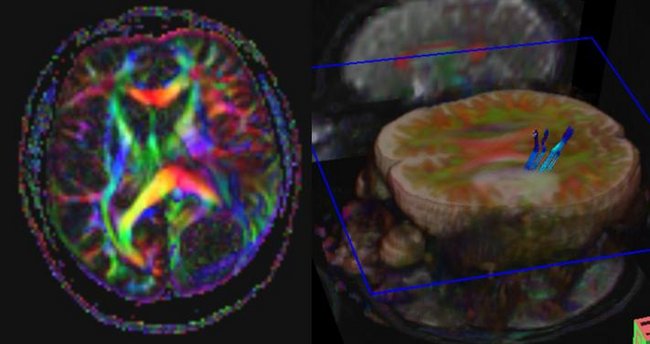 Radiologie, Neuroradiologie, MRT: Weitere Spezialtechniken (DTI / "Fiber Tracking") zur Rekonstruktion des Verlaufs größerer Nervenfaserbündel