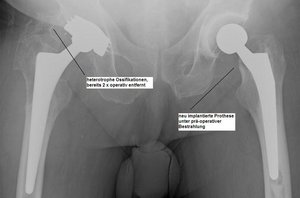 Klinik für Unfallchirurgie und Orthopädie, Handchirurgie, mögliche Komplikationen: Röntgen-Bild einer heterotoper Ossifikationen