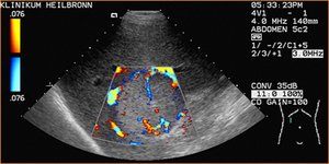 Sonograhisches Bild eines Lebertumors