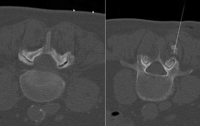 Neuroradiologie, Schmerztherapie: Direkte Behandlung an der Schmerzquelle bei Verschleisserscheinungen der kleinen Wirbelgelenke