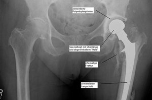 Röntgen-Bild einer Revisionsprothese nach fehlgeschlagener Osteosynthese