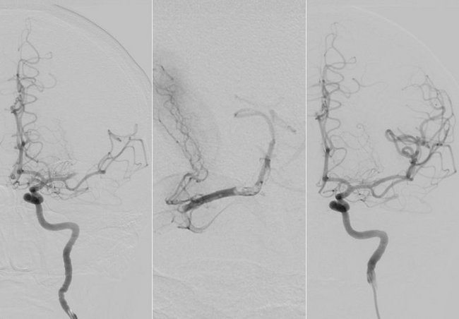 Neuroradiologie, Angiographie: Auflösung eines zum Schlaganfall führenden Gerinnsels in einer vorderen Kopfarterie
