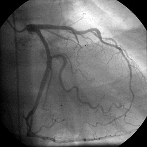 Koronarangiografie der linken Herzkranzarterie