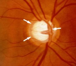 Das Glaukom, oft auch „Grüner Star“ genannt, ist die häufigste Erkrankung des Sehnervs.