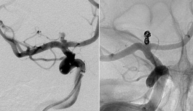 Neuroradiologie, Angiographie: Verschluss einer Gefäßaussackung im Kopf mit Platinspiralen