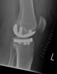 Kniegelenk, Knie-Teilprothese, Schlittenprothese 2