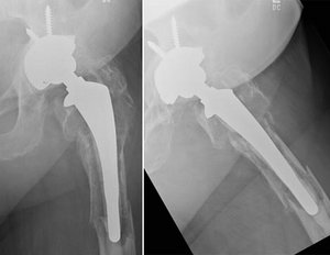 Prothesenwechsel: Ausgelockerter zementierter Schaft mit mehrfach gebrochenem Oberschenkelknochen