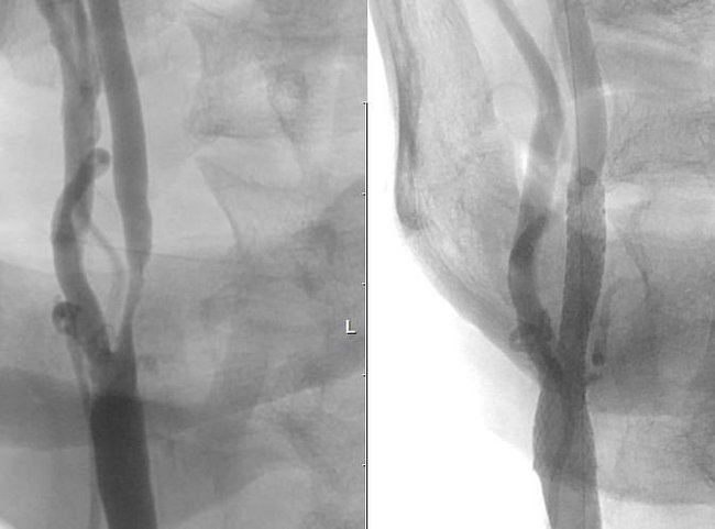 Angiographie: Schlaganfall infolge einer Einengung der rechten Halsschlagader. Vor und nach minimal-invasiver Therapie.