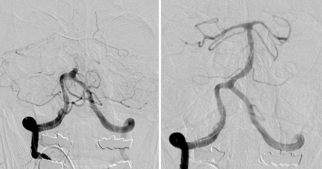 Neuroradiolgie, Angiographie: Verschluss einer Arterie am Hinterkopf, rechtzeitige Wiedereröffnung