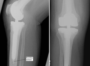 Röntgen-Bild einer Revisionsprothese nach Prothesenlockerung