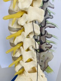 Epiduroskopie: Zugang zum Epiduralraum