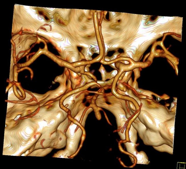Neuroradiologie, CT: Detailreiche Darstellung der Hirnarterien und des Schädelknochens