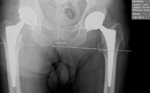 Klinik für Unfallchirurgie und Orthopädie, Handchirurgie, nach der Operation: Röntgen-Bild der Beinlängendifferenz nach Prothesenimplantation beidseits