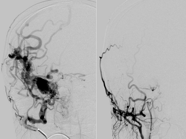 Neuroradiologie, Angiographie: Abnormale Verbindungen von Gefäßen des Kopfes, vor und nach Therapie