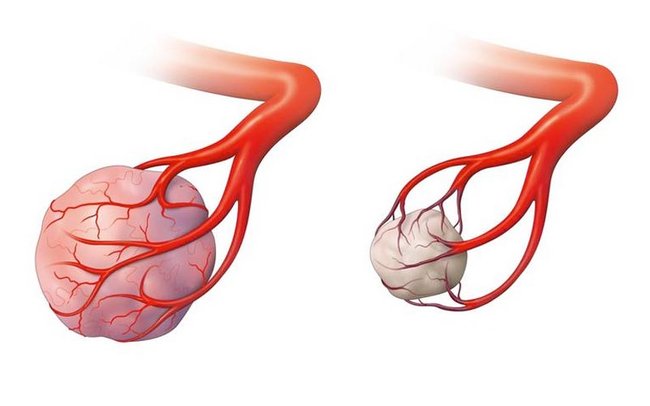 Gefäßversorgung eines Uterusmyoms