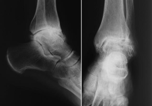 SLK Kliniken: Sprunggelenk