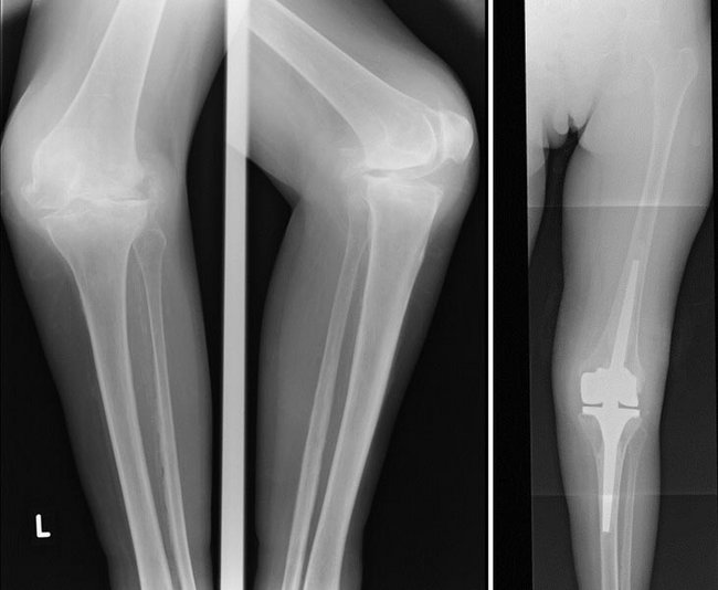 Abbildung 4: Der Knochenverlust an der äußeren Oberschenkelrolle, der zur Fehlstellung führte, ist links im Bild gut zu sehen. Rechts das korrigierte Bein.