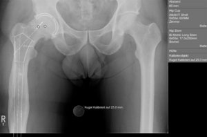 Prä-operative Planung einer Spezialprothese