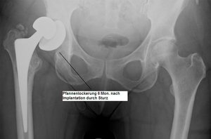 Klinik für Unfallchirurgie und Orthopädie, Handchirurgie, mögliche Komplikationen: Röntgen-Bild einer aseptischen Pfannenlockerung sturzbedingt