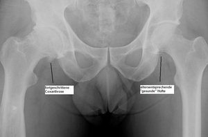 Klinik für Unfallchirurgie und Orthopädie, Handchirurgie: Röntgen-Bild einer gesunden und einer arthrotisch veränderten Hüfte