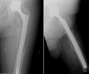 Der Knochenbruch wurde mit einem zementfreien Schaft überbrückt und stabilisiert. Der Knochen kann nach dem Wechsel wieder zusammenwachsen, die Defekte schliessen sich nach Monaten.