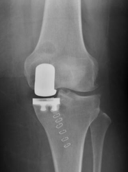 Kniegelenk, Knie-Teilprothese, Knieinnenseite, Schlittenprothese