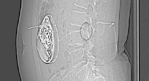 Intrathekale medikamentöse Nervenmodulation: CT-Schnittbild einer implantierten Medikamentenpumpe