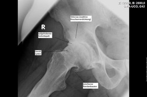 Klinik für Unfallchirurgie und Orthopädie, Handchirurgie, Röntgen-Bild einer Coxarthrose