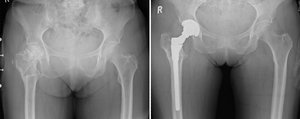 Abbildung 2: Auf dem rechten Bild ist erkennbar, dass der Oberschenkelknochen wieder in der natürlichen Position unter dem Drehpunkt des Hüftgelenkes steht.