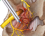 Endoskopische Facettendenervierung: minimalst-invasive Diagnostik und Therapie gleichzeitig 