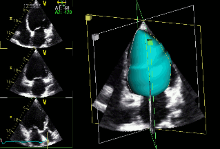 Bestimmung der Pumpfunktion der linken Herzkammer aus einem 3D-Datensatz.