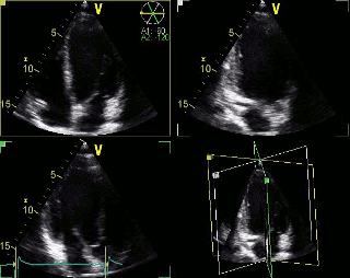 Normale Herzfunktion in der 3D-Echokardiographie mit gleichzeitiger Darstellung von drei Schnittebenen 