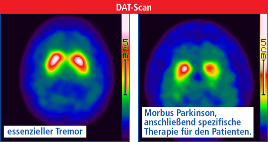 DAT-Scan - Parkinson oder | SLK-Kliniken