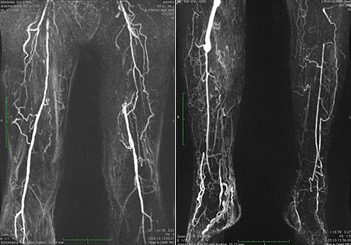 Gefäßdarstellung der Beinschlagader mittels Kernspin-Untersuchung