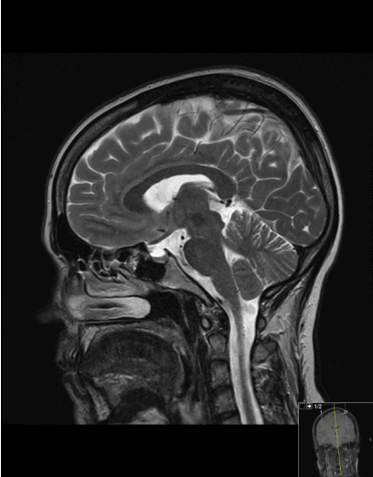Radiologie, Neuroradiologie: MRT vom Kopf in sagittaler Achse