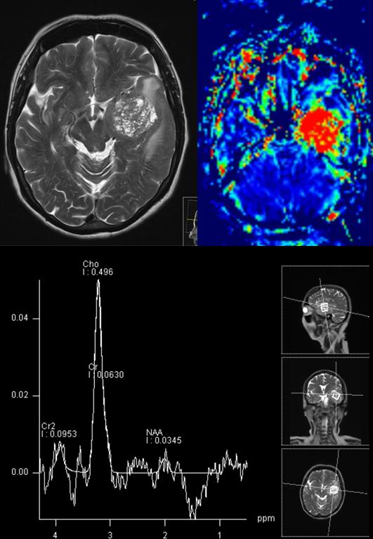 Radiologie, Neuroradiologie, MRT: Hirntumor mit Spezialaufnahmen (Perfusion, Spektroskopie) zur weiteren Abklärung