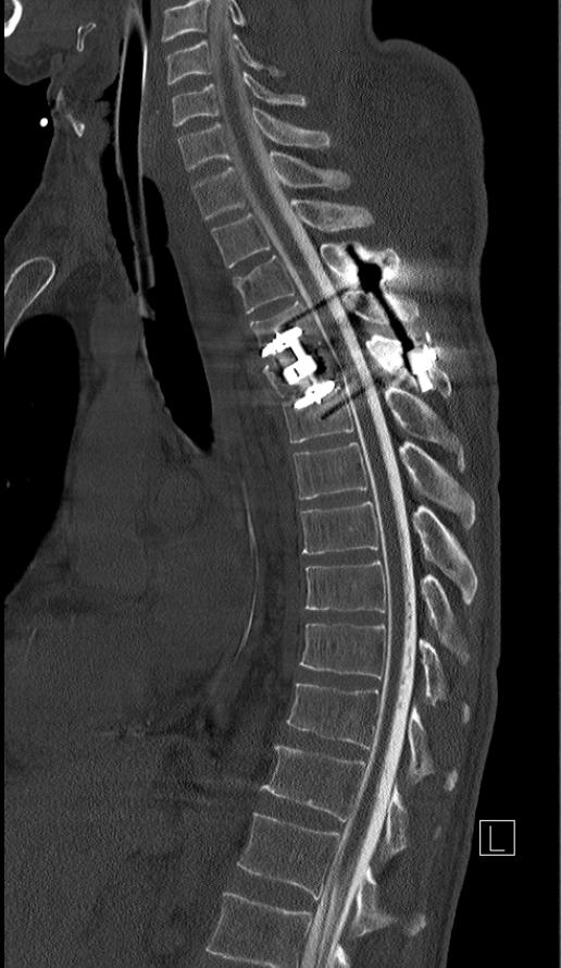 Neuroradiologie, Myelographie, Kontrolle der Durchgängigkeit des Nervenwasserkanals nach Wirbelsäulenoperation