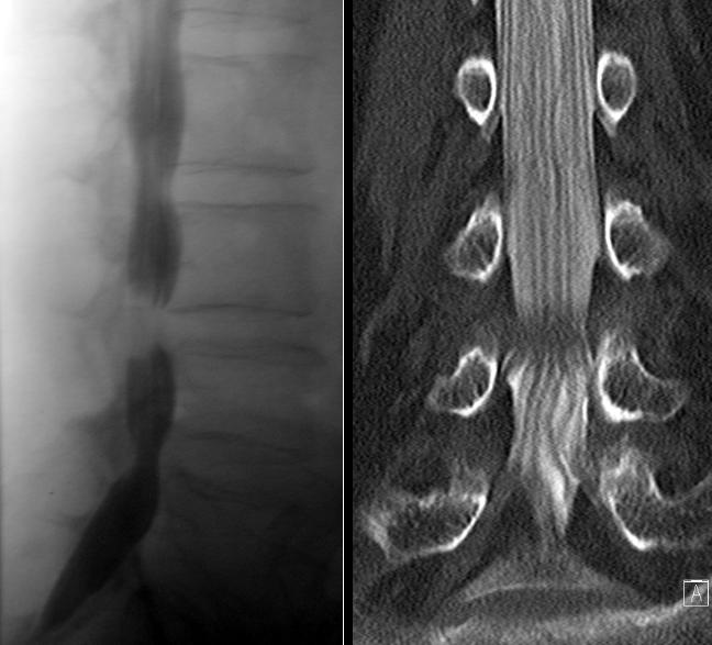 Neuroradiologie, Myelographie: Hochgradige Enge des Nervenwasserkanals bei Verschleisserscheinungen der Wirbelsäule